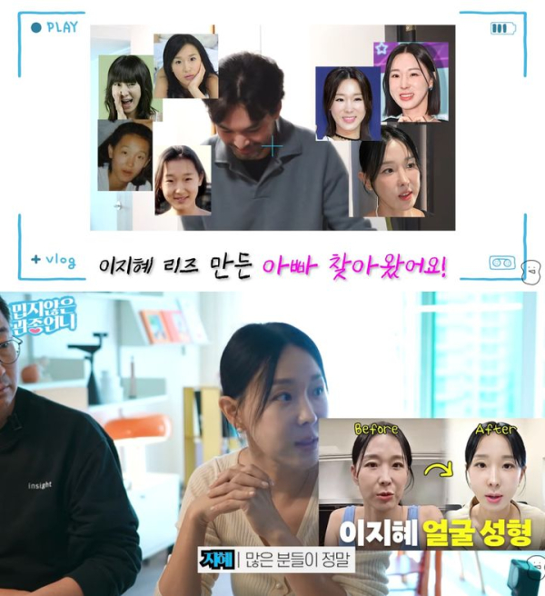 이지혜 리프팅 시술 후기 공개…주치의와 관리법 소개
