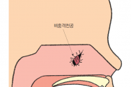 비중격천공