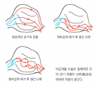 빈코증후군