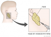 침샘암 검사 방법 세침흡인검사 모식도