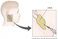 침샘암 검사 방법 세침흡인검사 모식도